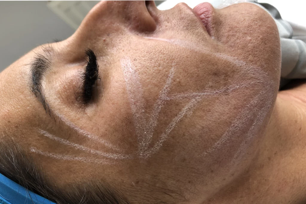 Tratamentos de estetica facial com Karla Fontoura 